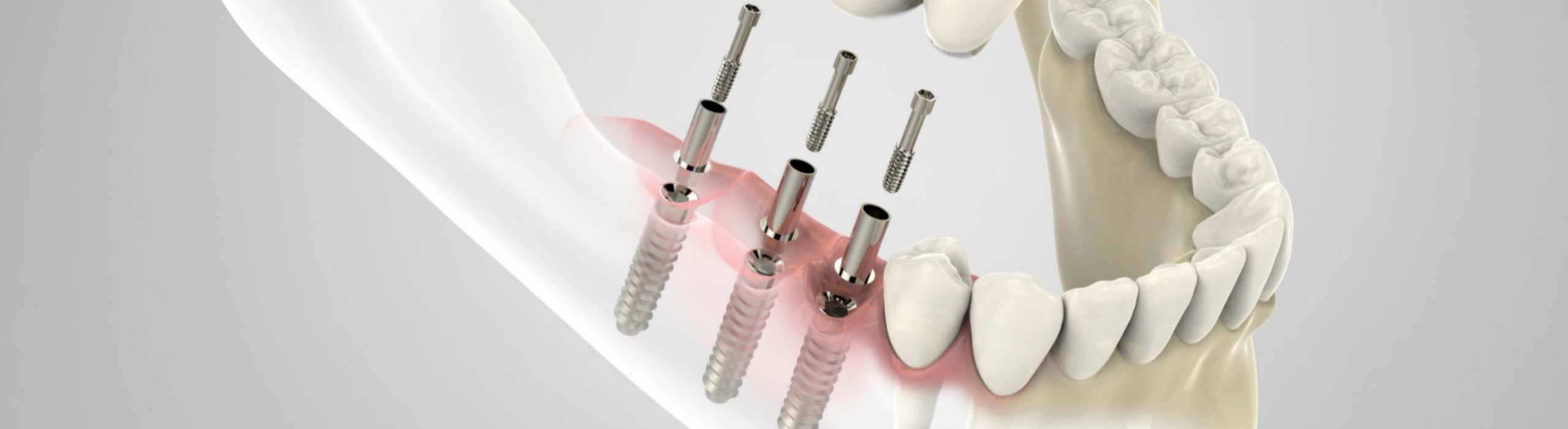 Implantologia dentale